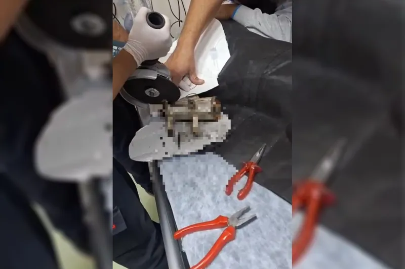 Şanlıurfa’da küçük Sara’nın eli kıyma makinesinden kurtarıldı